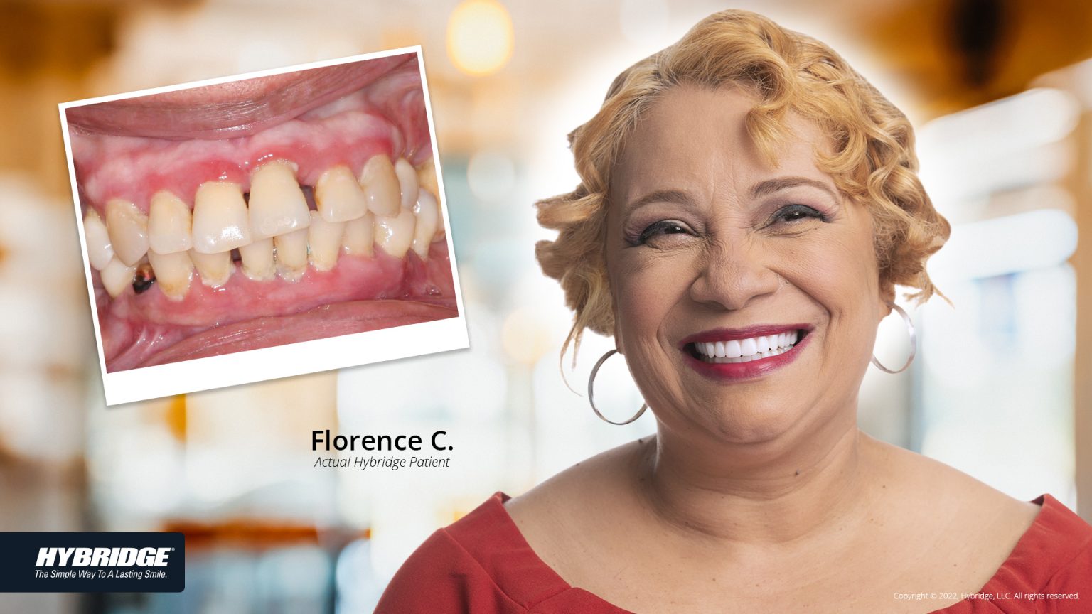 Hybridge Dental Implants North Austin Dentistry Logan Miller, DDS